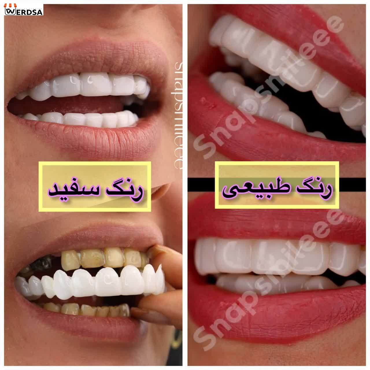 لمینت snap on smile برای دو فک طرح وردسا